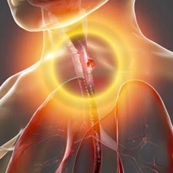 РАК ПИЩЕВОДА